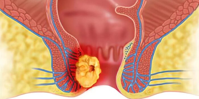 7–14 Hari Wasir Bisa Lepas Sampai Akar, Fakta Pengobatan dengan Salep Oles yang Perlu Anda Tahu