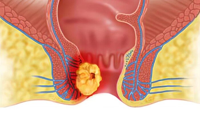 7–14 Hari Wasir Bisa Lepas Sampai Akar, Fakta Pengobatan dengan Salep Oles yang Perlu Anda Tahu