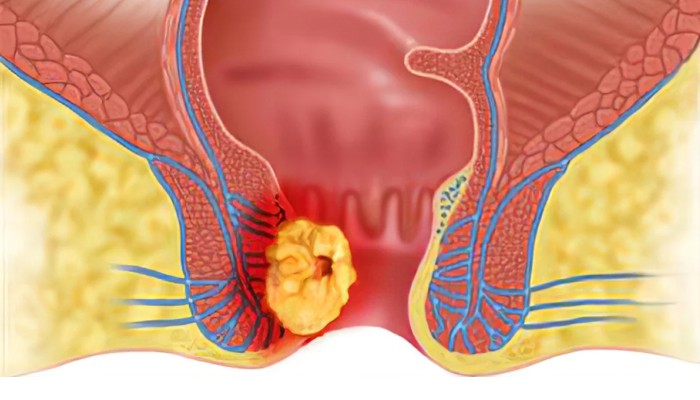 7–14 Hari Wasir Bisa Lepas Sampai Akar, Fakta Pengobatan dengan Salep Oles yang Perlu Anda Tahu