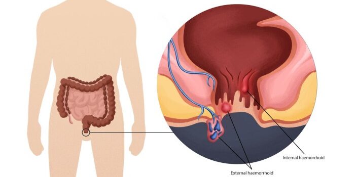 Cara Kerja Salep Oles dalam Mengatasi Wasir hingga Tuntas - Cepat, Aman, Tanpa Operasi