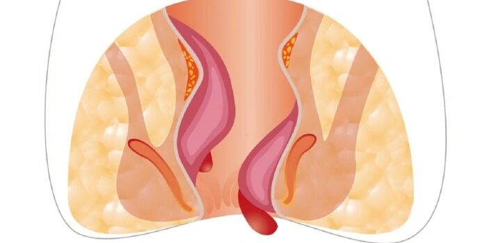 Mengapa Terapi Salep Oles Menjadi Solusi Terbaik untuk Wasir, Ini Penjelasan Lengkapnya